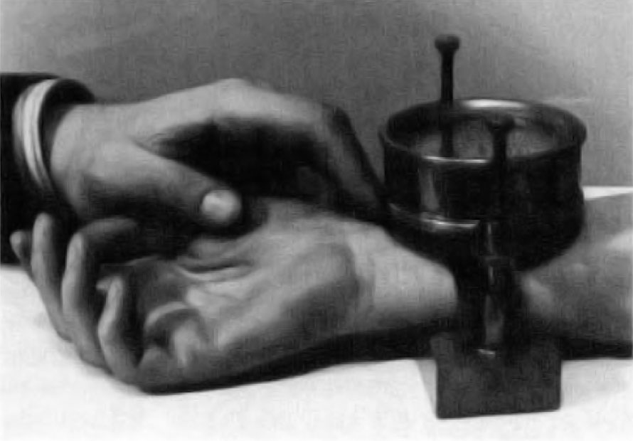 Fig. I Pulse Controller. made by Castagna of Vienna. 1885. A clock measures the pressure of a screw type clamp required to obliterate the arterial pulse at the wrist. Image included by permission of John Wiley and Sons, Inc. Further usage of any Wiley content that appears on this website is strictly prohibited without permission from Wiley and Sons, Inc.